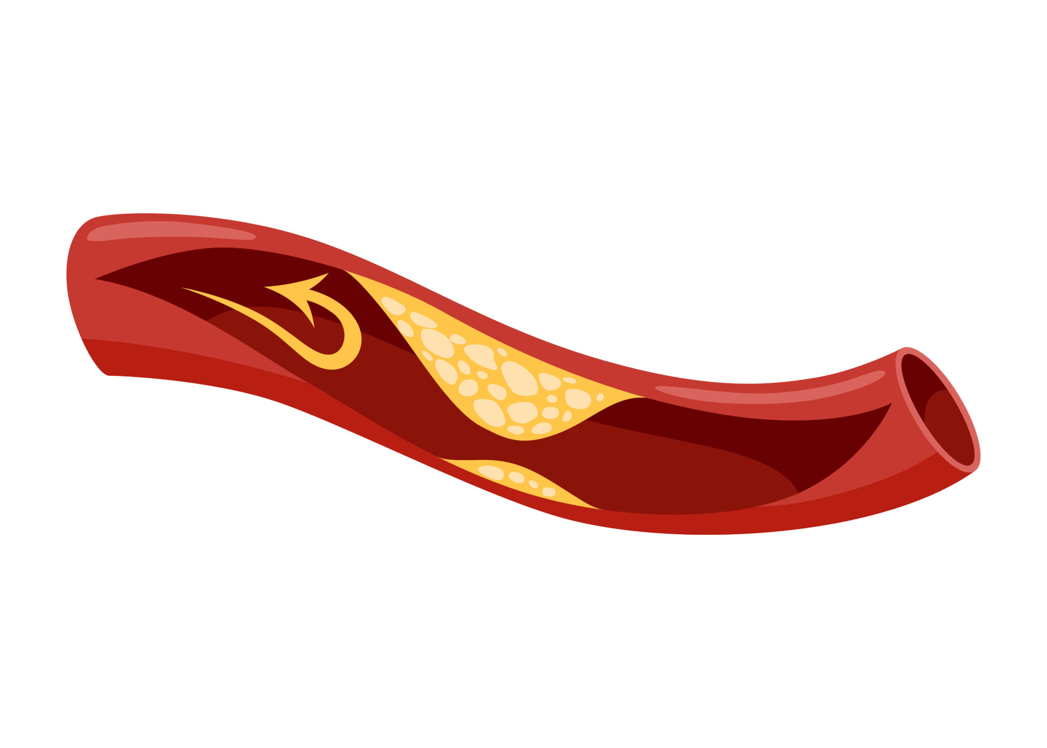 Atherosclerosis Stage. Anatomy Of Heart Attack. Arteriosclerotic Vascular Disease Or Asvd. Atherosclerotic Plaque In Coronary Artery. Illustration On White Background Atherosclerosis Stage. Anatomy Of Heart Attack. Arteriosclerotic Vascular Disease Or Asvd. Atherosclerotic Plaque In Coronary Artery. Illustration On White Background