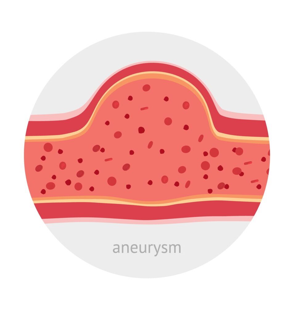 Healthy And Sick Aneurysm Human Vessel Healthy And Sick Aneurysm Human Vessel