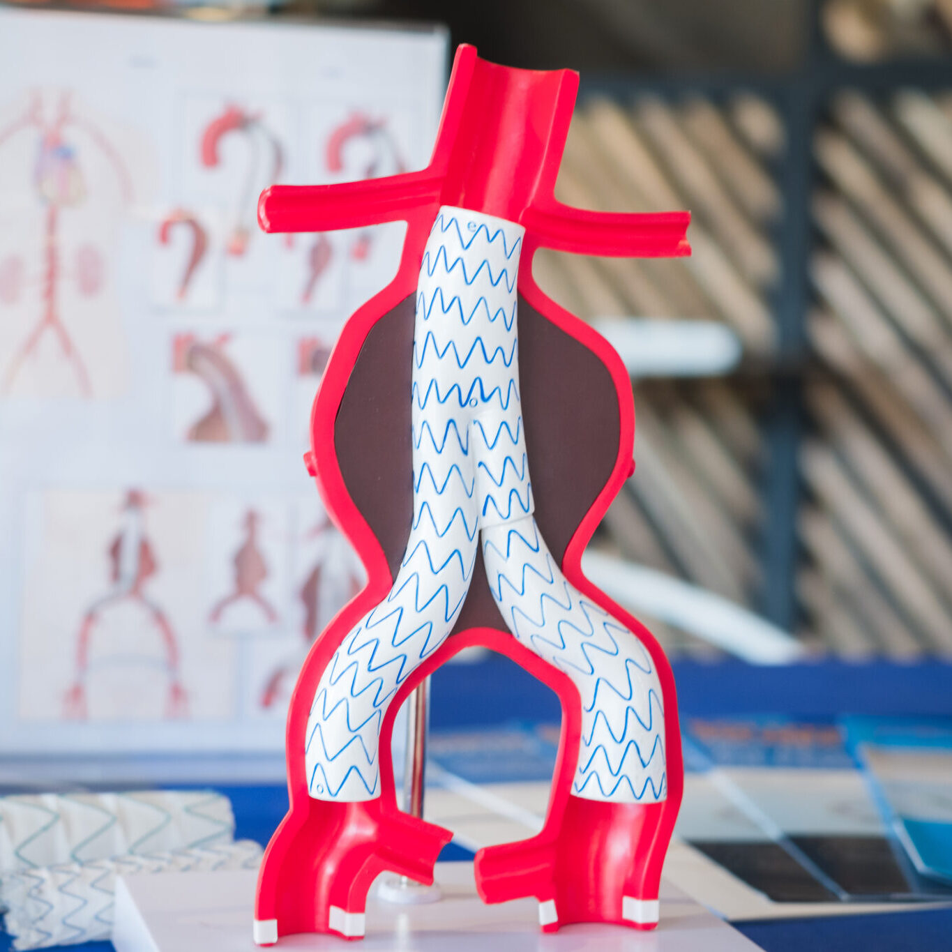Model Of Endovascular Aneurysm Repair (evar) For Peoples Education. Model Of Endovascular Aneurysm Repair (evar) For Peoples Education.