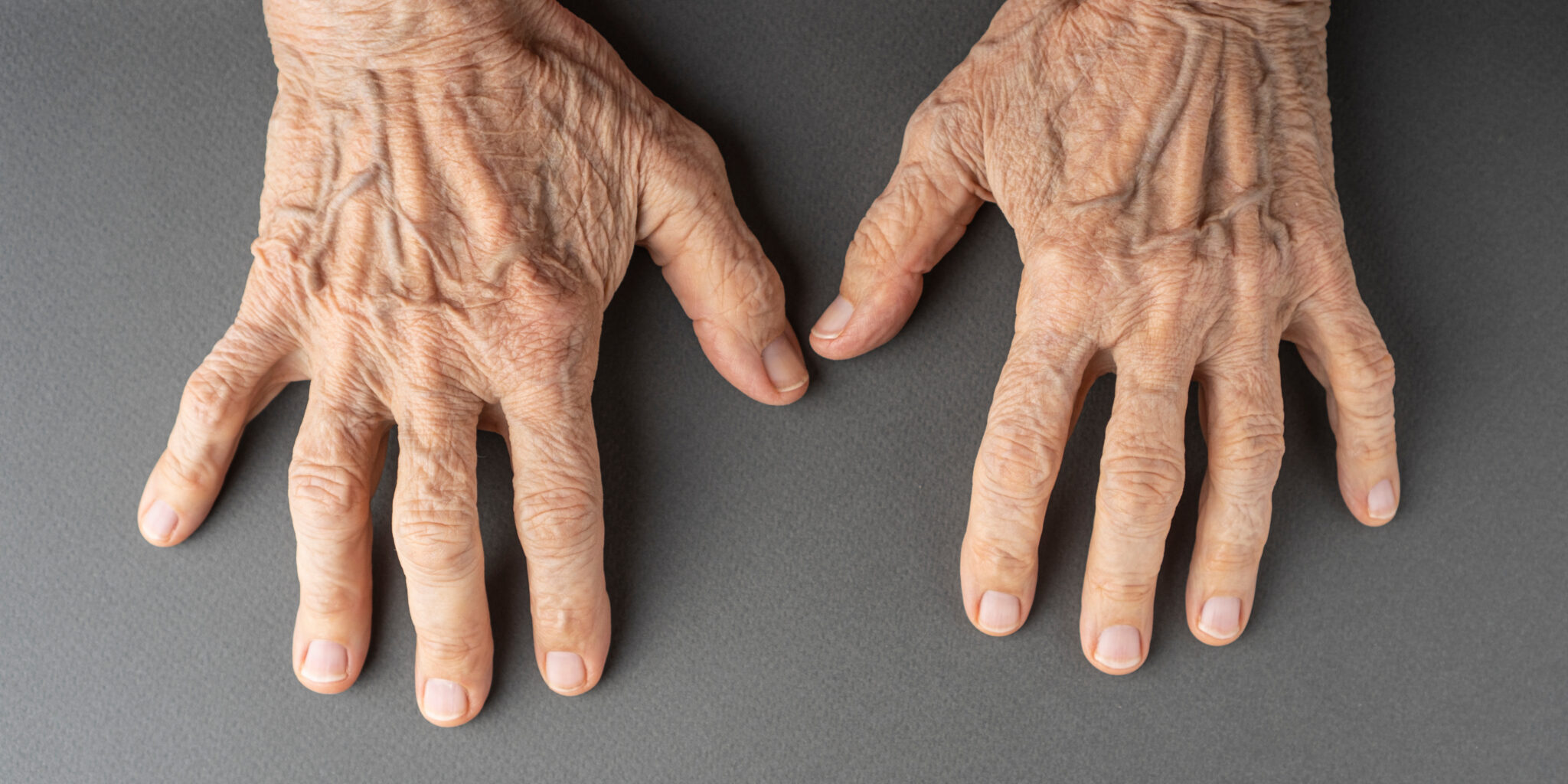 Old Wrinkled Hands With Veins Closeup.