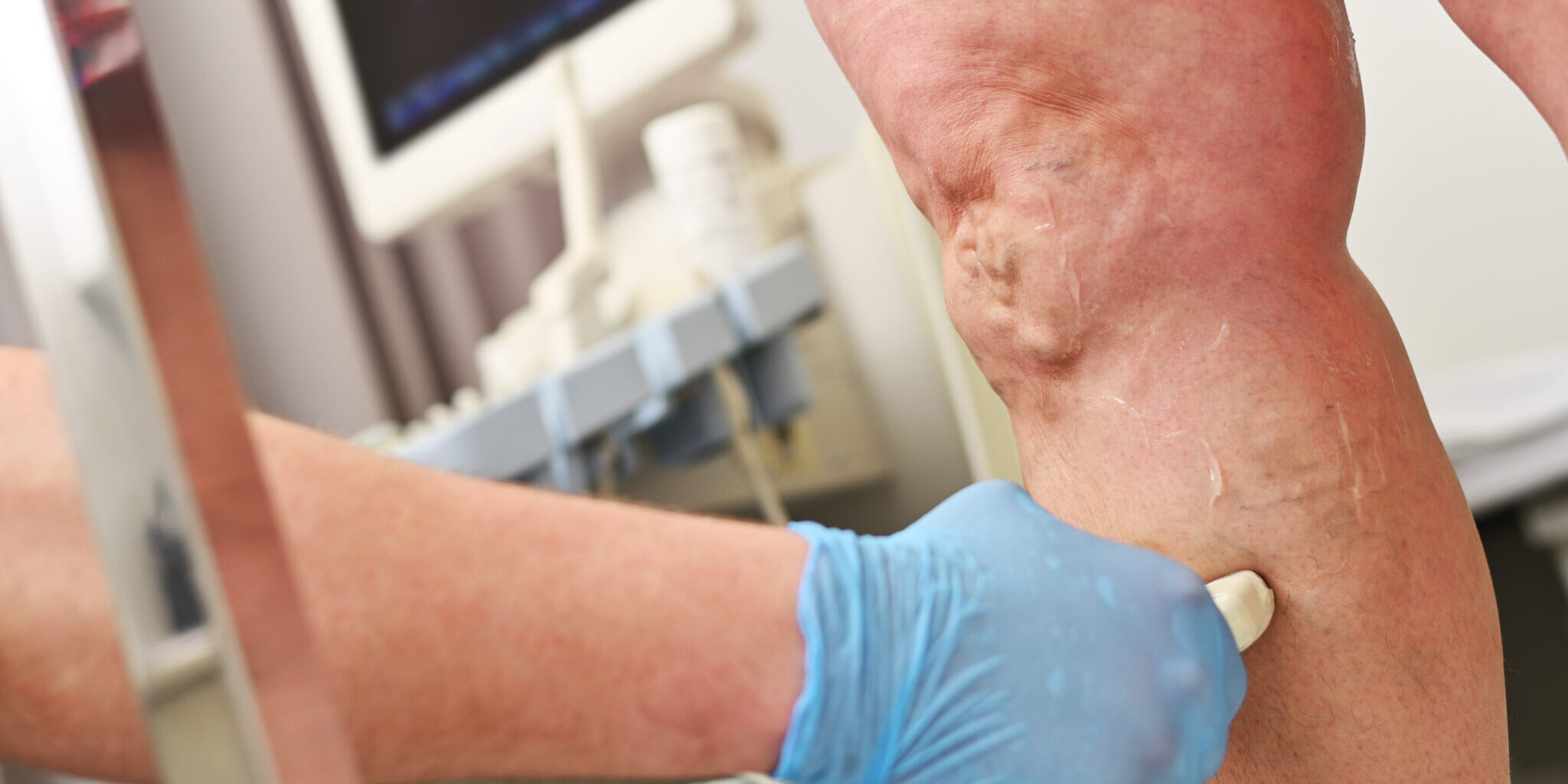 A Phlebologist Does An Ultrasound Of The Veins Of A Patient With Varicose Veins.