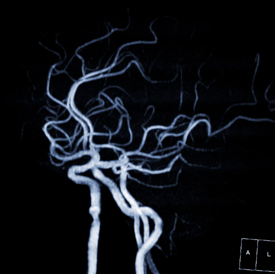 Mra Brain , This Imaging Technique Provides Clear Visuals Of The Brain's Arterial And Venous Structures, Aiding In The Diagnosis Of Vascular Conditions And Neurological Issues. Mra Brain , This Imaging Technique Provides Clear Visuals Of The Brain's Arterial And Venous Structures, Aiding In The Diagnosis Of Vascular Conditions And Neurological Issues.