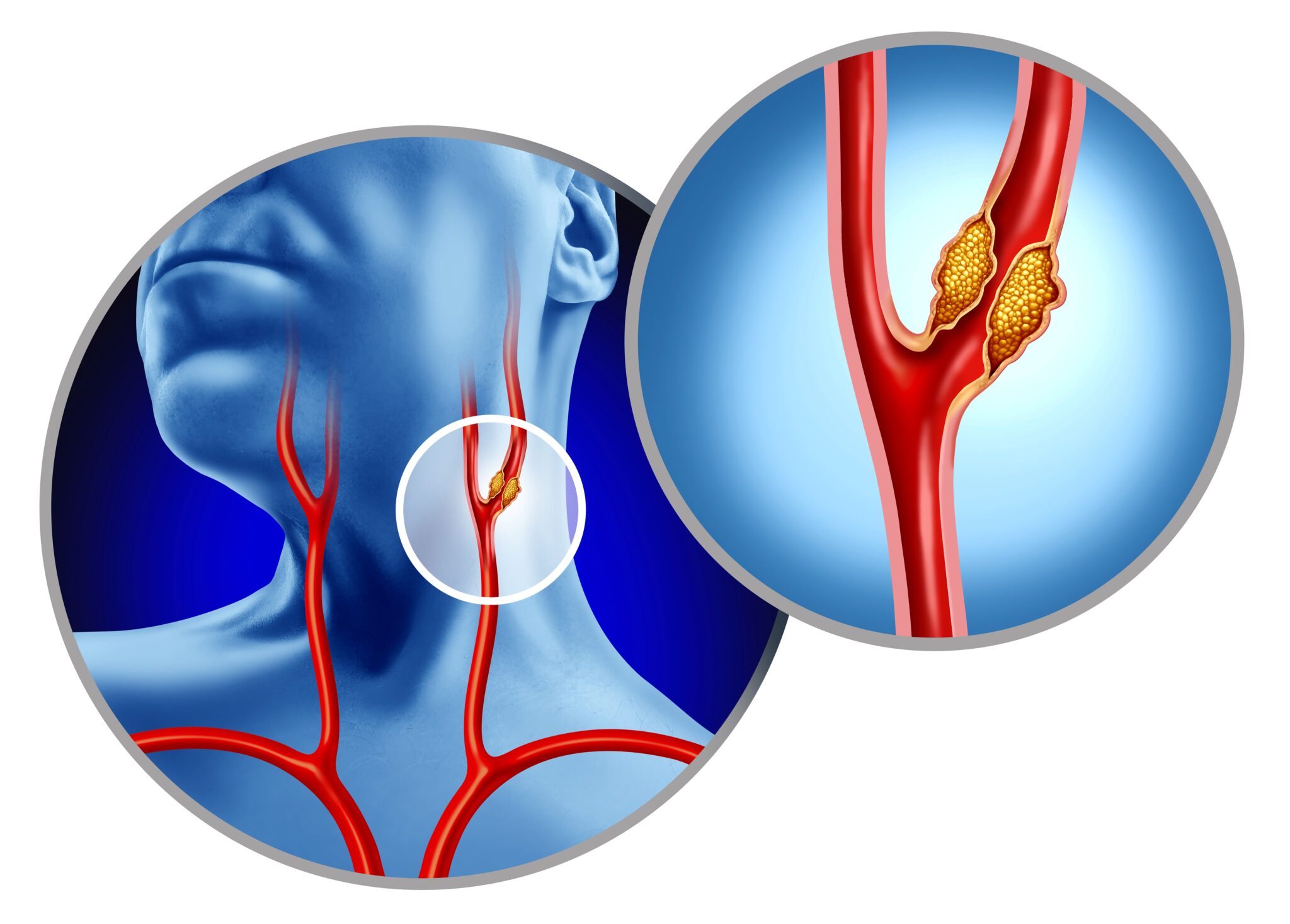 Carotid Artery Disease Carotid Artery Disease
