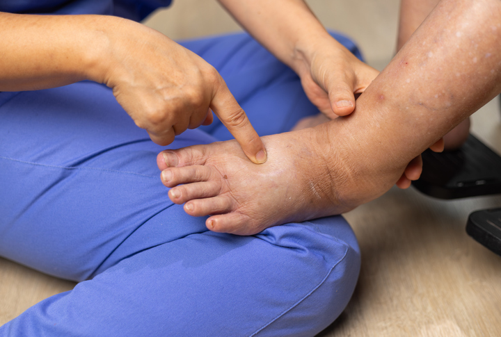 Elderly Woman Has Edema Or Swelling Foot. Elderly Woman Has Edema Or Swelling Foot.