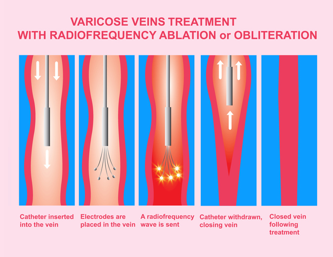 Varicose Veins And Treatment With Radiofrequency Ablation Varicose Veins And Treatment With Radiofrequency Ablation