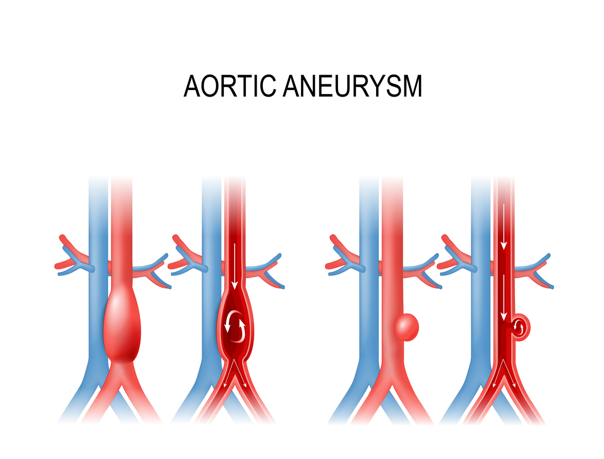 Aortic Aneurysm Aortic Aneurysm