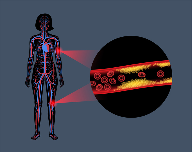 Peripheral Artery Disease Pad Peripheral Artery Disease Pad