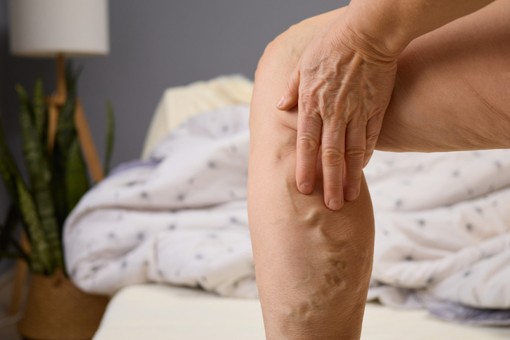 A Person Is Sitting On A Bed, Looking Thoughtfully At Their Leg And Gently Touching Visible Varicose Veins. Soft Lighting Enhances The Cozy Atmosphere Of The Room A Person Is Sitting On A Bed, Looking Thoughtfully At Their Leg And Gently Touching Visible Varicose Veins. Soft Lighting Enhances The Cozy Atmosphere Of The Room