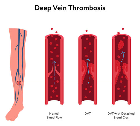 Deep Vein Thrombosis For Healthcare Infographic. Vector Flat Character Illustration. Vascular Disease Diagnostic And Treatment. Human Veins With Dvt And Blood Clot. Design For Health Care, Education Deep Vein Thrombosis For Healthcare Infographic. Vector Flat Character Illustration. Vascular Disease Diagnostic And Treatment. Human Veins With Dvt And Blood Clot. Design For Health Care, Education