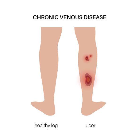 Trophic Ulcer Anatomy Trophic Ulcer Anatomy